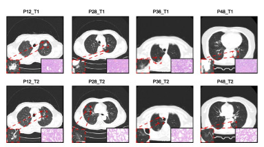 B4GALT1 Promotes Immune Escape in Lung Adenocarcinoma