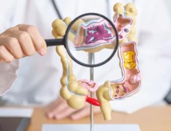 Molecular Mechanisms Underlying the Development of Colitis in Cancer Immunotherapy Induced Patients