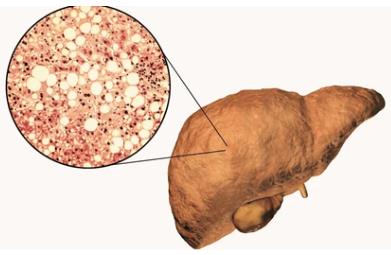 TRIB3-TRIM8 Complex Regulates HNF4Α Stability to Promote the Progression of Non-Alcoholic Fatty Liver Disease