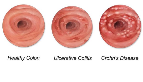 Therapy in Inflammatory Bowel Diseases