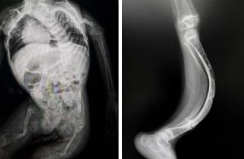 IFITM5 Mutation Causes Abnormal Differentiation of Bone Marrow Cells, Leading To V-Type Osteogenesis Imperfect