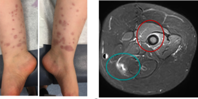 Discovering an Autoimmune Inflammatory Disease Induced by LYN Gene Mutation