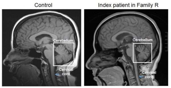 XRCC1 Mutation Is Associated With Cerebellar Ataxia