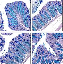 Key Protective Proteins Affect the Prognosis of Patients with Type 2 Diabetes Isolated Recently