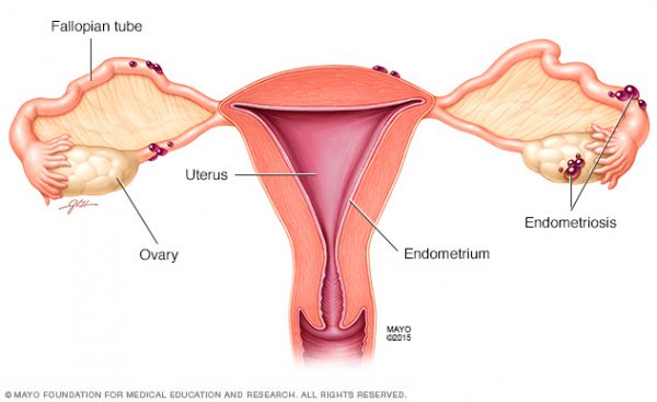 DcR3 Is the Key Factor of Endometriosis, Academia Sinica Found