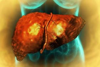 How Does Steatohepatitis Develop Into Liver Cancer