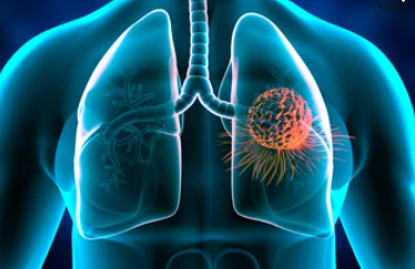 Interferon-gamma (IFNG) drives regulatory T cells to restrain DC1-mediated priming of cytotoxic T cells against lung cancer