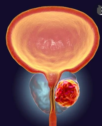 ROR2 may be a potential biomarker of prostate cancer