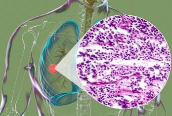 Revealing Prognostic Markers for Small Cell Lung Cancer