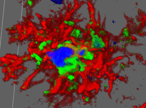 Insufficient Sleep Can Lead to Dementia, Affecting the Clearance of Toxic Proteins in the Brain and Increasing the Risk of Dementia