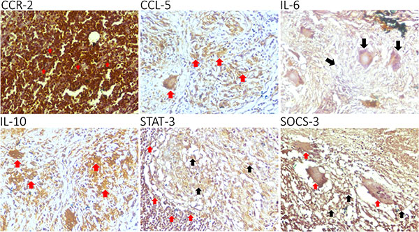 Immunohistochemistry images for characterization of chemokine and cytokine expression pattern in tuberculous lymphadenitis patient.