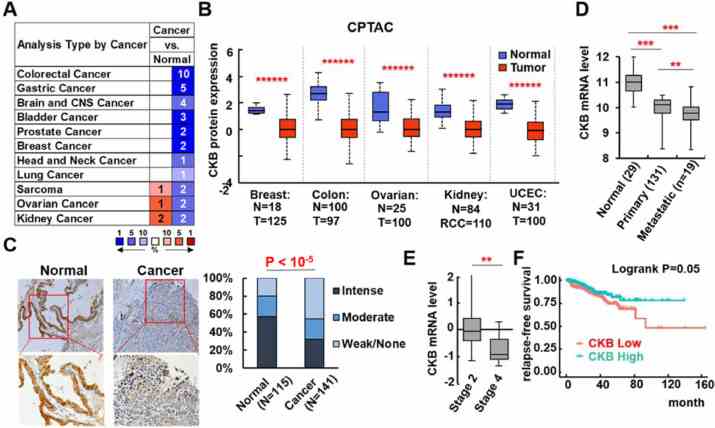 CKB is downregulated in human solid tumors, which is associated with poor prognosis. (A) CKB mRNA expression in normal vs tumor comparisons of various cancer types from Oncomine.org website. Significance thresholds are: P ≤ 1 × 10 ?4 , fold change ≥2, and gene rank top 10%. Red signifies over-expression and blue represents under-expression in tumors. Intensities of color signify the best ranks of CKB in the analyses. The numbers represent the numbers of analyses that meet the thresholds. (B) CKB protein expression in normal and tumor samples, and the P values, were from the CPTAC database, obtained through UALCAN. (C) CKB protein expression was analyzed in prostate normal and tumor tissue microarray by immunohistochemistry. Staining was scored for each sample, and percentage of weak, moderate or intense CKB staining in normal and tumor samples was shown on the right. P value was from Chi Square Test. (D-F) CKB mRNA expression was analyzed in Taylor_Prostate dataset (D), and in TCGA prostate cancer dataset for tumor stage (stage 2, n = 186 vs stage 4, n = 11) (E), and biochemical relapse (BCR) free survival time (F). ** P < 0.01, *** P < 0.001 were from 2-sided t test. In KM survival analysis (F), patients were categorized as CKB Low or High based on the ROC curve method, and the P value was from Logrank test (GraphPad Prism) (color version of figure is available online).