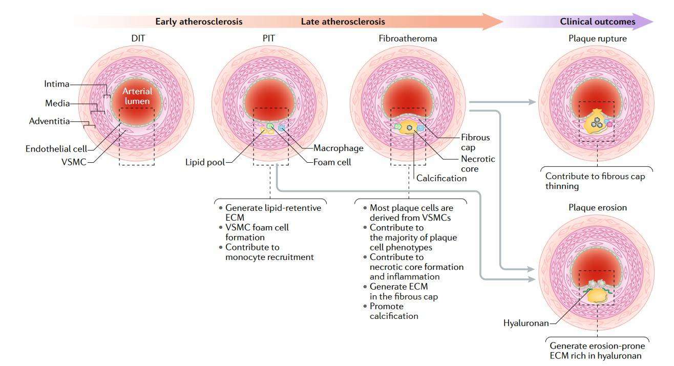 VSMCs contribute to plaque formation and ECM production in atherosclerosis, affecting diffuse and pathological intimal thickening stages.