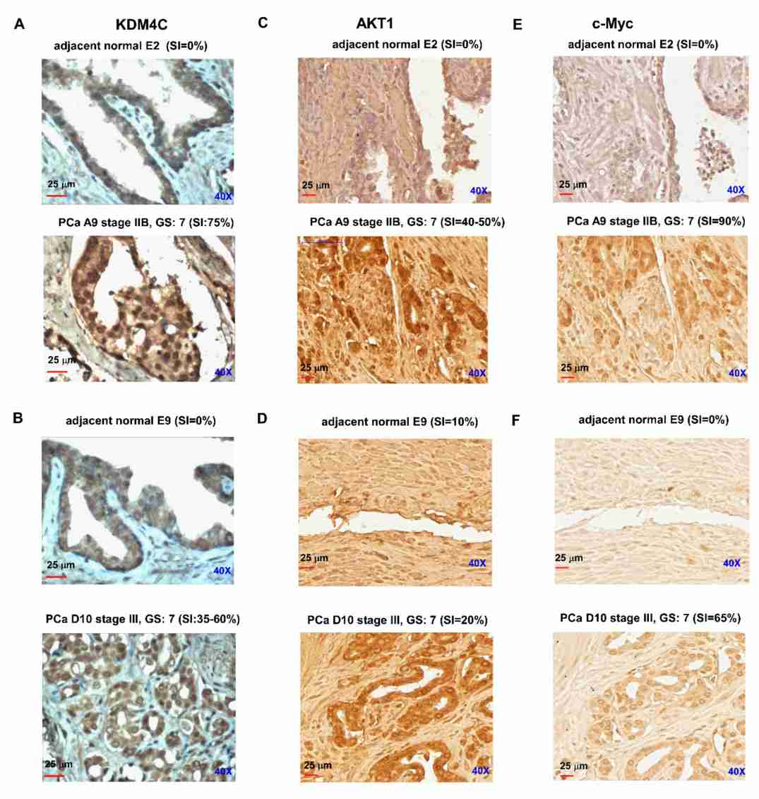 Protein expression level of KDM4C in prostate carcinoma versus adjacent normal prostate tissues.