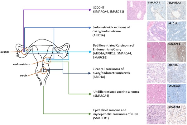 SWI/SNF mutations and protein loss in gynecologic cancers.