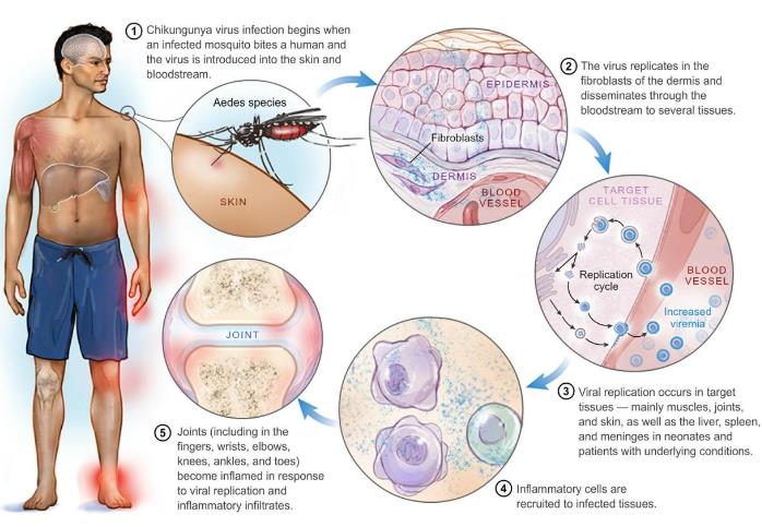 Successive steps of chikungunya virus infection in humans, based on human clinical data and animal experiments.